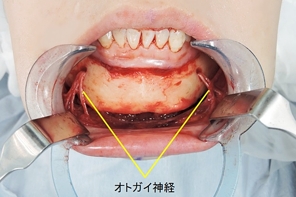 アゴ骨切り_オトガイ神経