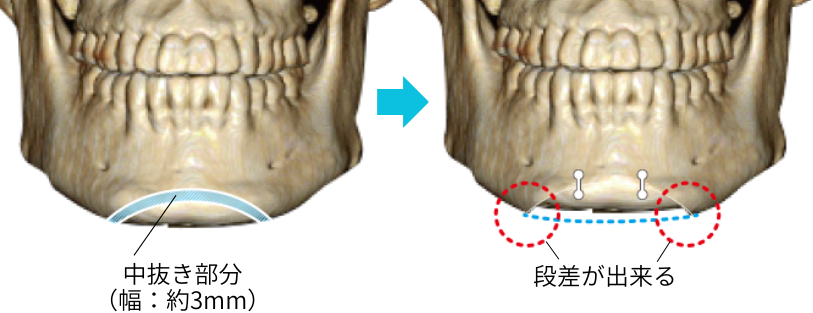 一般的な『オトガイ短縮術』_正面