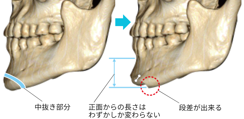 一般的な『オトガイ短縮術』_側面