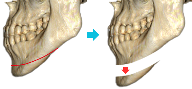 小木曽クリニックの『オトガイ広範囲骨切り縮小術』_側面