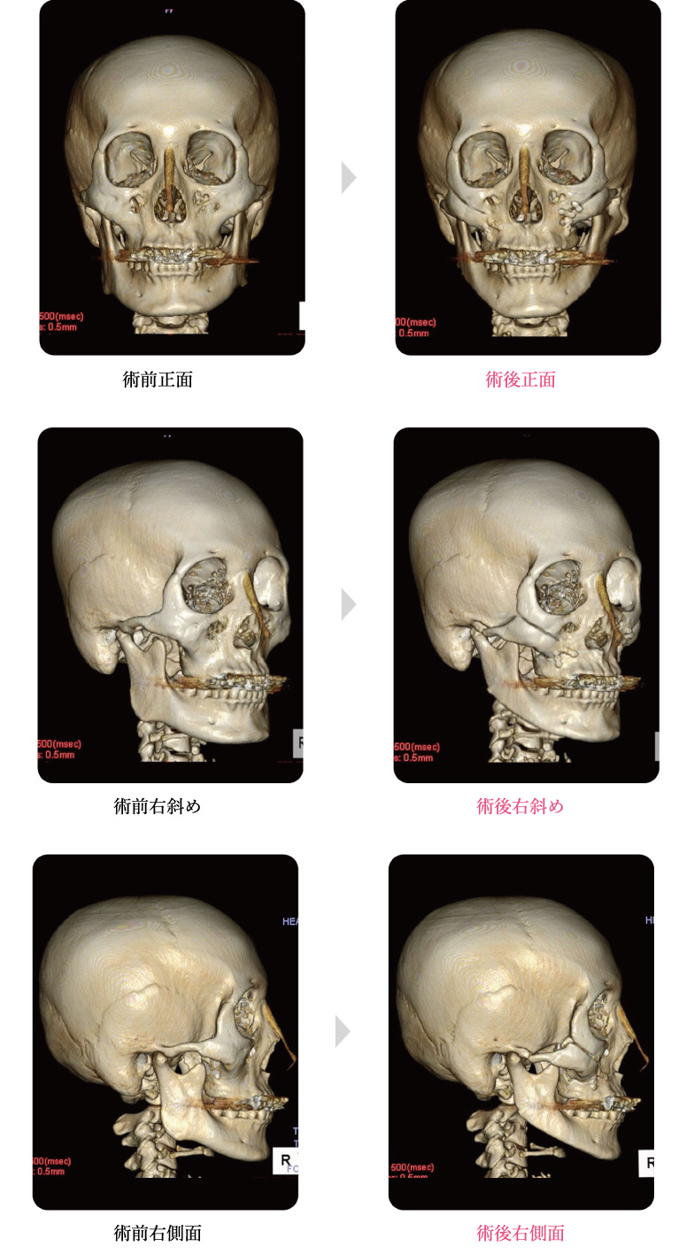 エラ削り（下顎角広範囲骨切り術）＋頬骨骨切り術　31歳女性