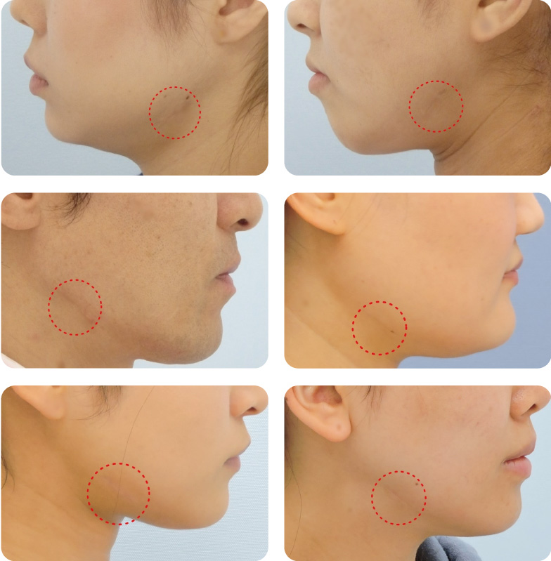 エラ削り（下顎角広範囲骨切り術）　傷痕6ヶ月後