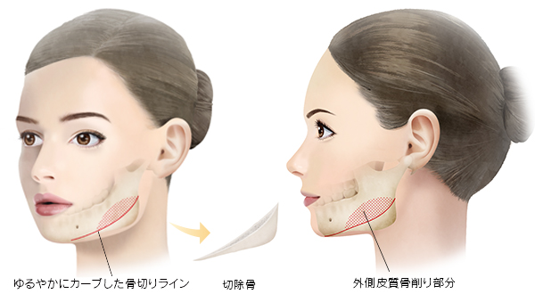 削り 費用 エラ