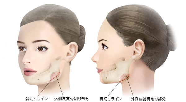 エラ削り（下顎角骨切り術・口腔内）