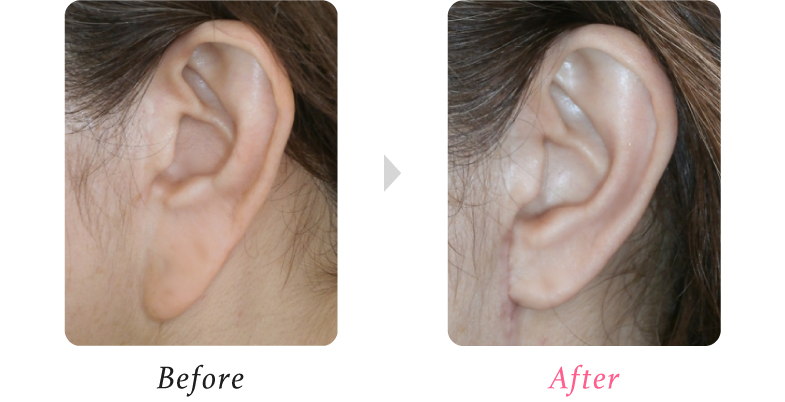 耳垂修正形成術 小木曽クリニック 美容外科 美容整形