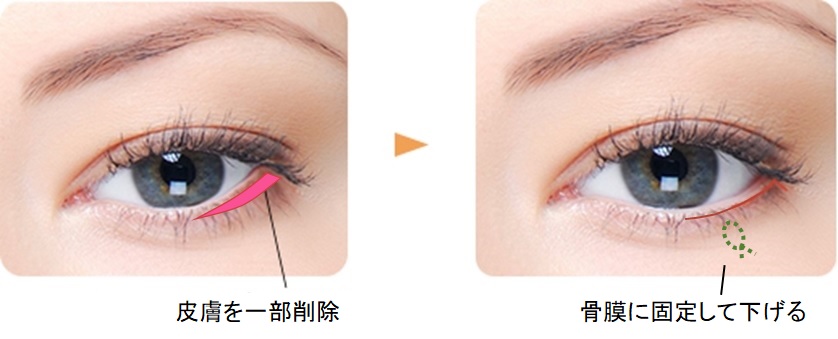 目頭 目尻の手術 小木曽クリニック 美容外科 美容整形