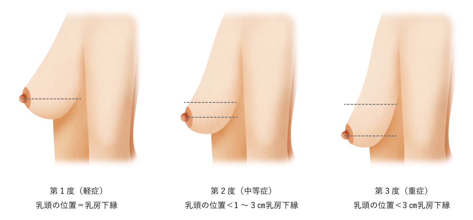 乳房吊り上げ術 (バストリフト) | 小木曽クリニック（美容外科・美容整形）