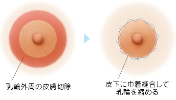 乳輪 乳輪周囲の医療脱毛 - レナトゥスクリニック東京田町新宿大阪仙台院