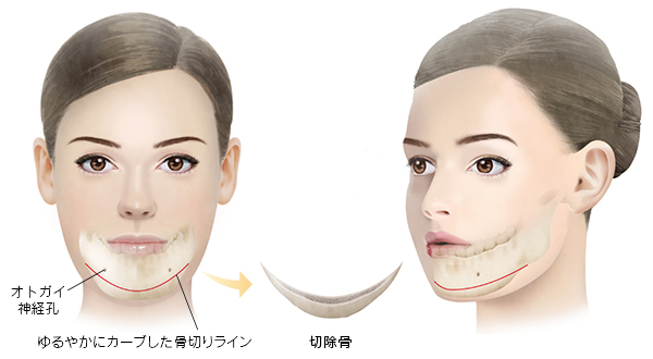 オトガイ形成（アゴ削り）