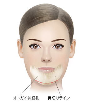 オトガイ骨先端骨切り術（あご削り）