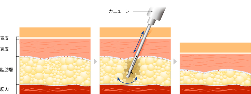 脂肪吸引