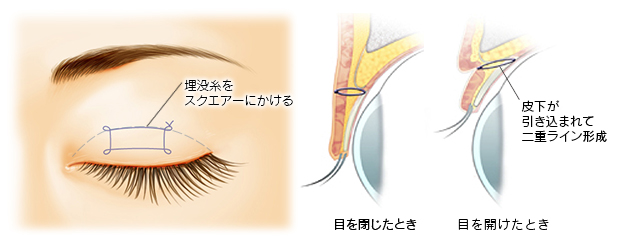 2点スクエアー法（二重埋没法）の説明図