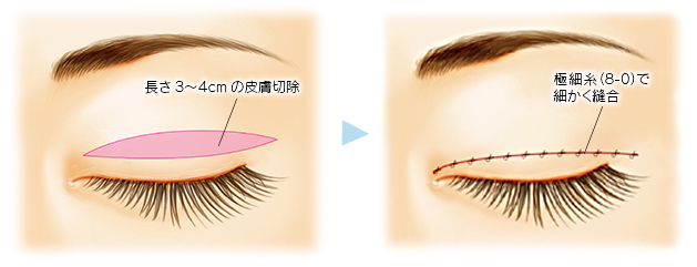 上眼瞼切開術の説明