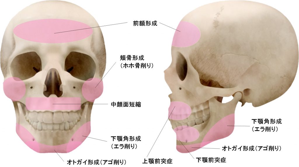 顔面輪郭形成 小木曽クリニック 美容外科 美容整形