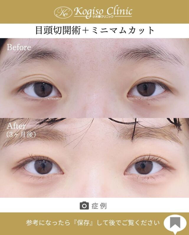 目頭切開術＋ミニマムカット法（最小切開法）

モウコヒダがなくなり、大人っぽく自然な二重に✨

【目頭切開術】
🩺施術内容
モウコヒダの部分を4mm位のZ型に切開し三角皮弁を入れ替える術です。緊張のかからない自然な方向に皮膚を移動する為モウコヒダをスムーズになくすことができ、腫れが少なく傷跡が残りにくいです。

💰施術費用
目頭切開術 ¥250,000 税抜
局所麻酔代、お薬代、検診代込み

🔹術後の経過など
腫れ→2〜5日をピークに1週間程
内出血→稀に出る場合がございますが1〜2週間程で消失
抜糸→1週間後に抜糸
切開創部→術後は多少赤みがございますが抜糸後はメイクでカバーできる程度で、3ヶ月程でほとんど目立たなくなります。

【ミニマムカット法(最小切開法)】
🩺施術内容
上瞼の皮膚の被りが強い方や瞼の脂肪が多い方、モウコヒダがある方に適しており、希望の二重ラインの中央を7〜8mm切開し、余分な脂肪を取り除き瞼板との間に強い癒着によって二重ラインを形成します。

💰施術費用
ミニマムカット法(最小切開法) ¥200,000 税抜
局所麻酔代、お薬代、検診代込み
術後１年以内に限りラインが消失してしまった場合は
左右1回ずつ無料で再手術が可能です。

🔹術後の経過など
腫れ→1週間程
内出血→稀に出る場合がございますが1週間程で消失
抜糸→1週間後に抜糸
切開創部→術後は多少赤みがございますが抜糸後はメイクでカバーできる程度で、3ヶ月程でほとんど目立たなくなります。

#ミニマムカット法 #最小切開 #最小切開法 #目頭切開 
#目頭切開法 #目頭切開経過 #二重 #二重整形 #目の整形
#美容整形前後 #美容整形 #美容外科 #小木曽クリニック