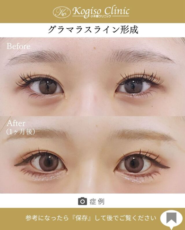 グラマラスライン形成•目尻下制術

自然なカーブで大きく可愛らしい印象のお目元に🥰

【グラマラスライン形成•目尻下制術】
🩺施術内容
目尻側の下まぶたを切開し、瞼板を骨膜に固定して目尻および下眼瞼外側下縁を下げます。骨膜に固定する為下制効果が大きく後戻りしにくい方法です。

💰施術費用
グラマラスライン形成•目尻下制術 ¥400,000 税抜
局所麻酔代、お薬代、検診代込み

🔹術後の経過など
腫れ→2〜３日をピークに1週間程
内出血→1〜２週間
抜糸→1週間後に抜糸
切開創部→術後多少赤みがございますが抜糸後はメイクでカバーできる程度で徐々に薄くなっていきます。

#グラマラスライン #グラマラスライン形成 #タレ目形成 #目尻下制 #目尻下制手術  #美容整形前後 #目の整形 #美容整形 #美容外科 #小木曽クリニック