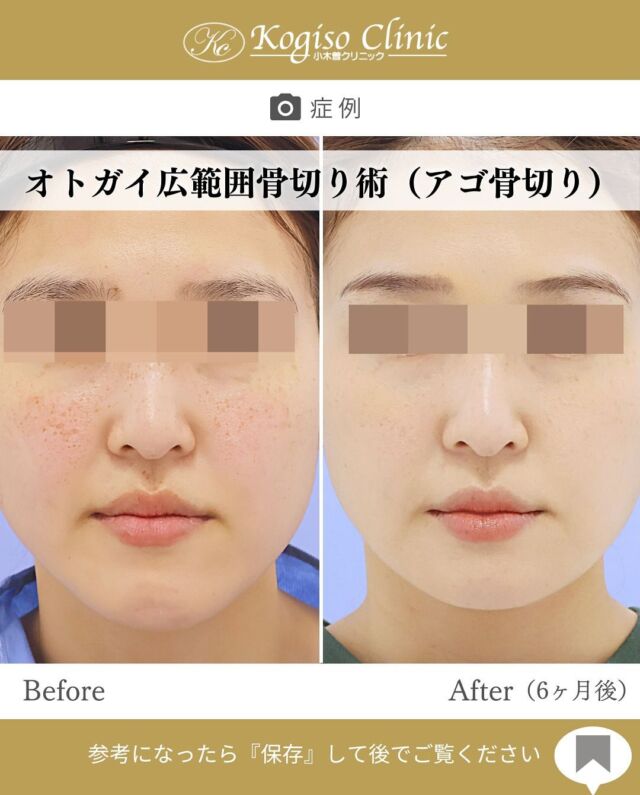 オトガイ広範囲骨切り術

どの角度から見ても自然で小さくスッキリした輪郭に✨

【オトガイ広範囲骨切り術】
🩺施術内容
当院のオトガイ広範囲骨切り術はオトガイ神経を剥離し、
オトガイ部から下顎角直前にわたりスムーズなカーブを
描きながら広範囲に骨切りするため、切除量が多く変化が大きいだけでなく自然な仕上がりです。

💰施術費用
オトガイ広範囲骨切り術 ¥1,500,000〜税抜
修正の場合は上記価格に修正費がプラスとなります。
別途全身麻酔•物品•検査代計 ¥233,090

🔹術後の経過など
腫れ→個人差はありますが1週間をピークに2週間ほどで大きな腫れは徐々に引いていきます
圧迫固定→術後3日間は24時間フェイスバンテージにて圧迫します
痺れ→オトガイ神経を剥離して手術を行うため、術後しばらく口の周りの感覚が鈍くなります。個人差がありますが6ヶ月程で徐々に回復していきます。
検診→翌日、1ヶ月、6ヶ月
翌日検診の際にドレーンチューブを抜去します。

#輪郭形成 #輪郭整形 #骨切り #アゴ整形 #顎 #輪郭手術 
#骨切り手術 #輪郭整形ビフォーアフター #輪郭整形症例写真 #顔面整形#フェイスライン #美容整形前後 #美容整形 #美容外科 #小木曽クリニック