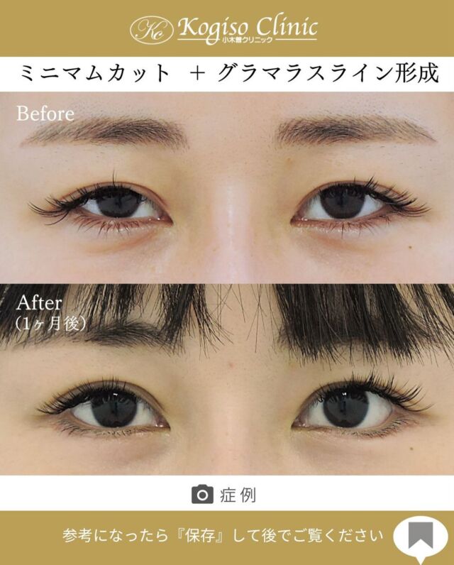 ミニマムカット法＋グラマラスライン形成•目尻下制術

目の幅が広がり可愛らしいお目元に💜

【ミニマムカット法(最小切開法)】
🩺施術内容
上瞼の皮膚の被りが強い方や瞼の脂肪が多い方、モウコヒダがある方に適しており、希望の二重ラインの中央を7〜8mm切開し、余分な脂肪を取り除き瞼板との間に強い癒着によって二重ラインを形成します。

💰施術費用
ミニマムカット法(最小切開法) ¥200,000 税抜
局所麻酔代、お薬代、検診代込み
術後１年以内に限りラインが消失してしまった場合は
左右1回ずつ無料で再手術が可能です。

🔹術後の経過など
腫れ→1週間程
内出血→稀に出る場合がございますが1週間程で消失
抜糸→1週間後に抜糸
切開創部→術後は多少赤みがございますが抜糸後はメイクでカバーできる程度で、3ヶ月程でほとんど目立たなくなります。

【グラマラスライン形成•目尻下制術】
🩺施術内容
目尻側の下まぶたを切開し、瞼板を骨膜に固定して目尻および下眼瞼外側下縁を下げます。骨膜に固定する為下制効果が大きく後戻りしにくい方法です。

💰施術費用
グラマラスライン形成•目尻下制術 ¥400,000 税抜
局所麻酔代、お薬代、検診代込み

🔹術後の経過など
腫れ→2〜３日をピークに1週間程
内出血→1〜２週間
抜糸→1週間後に抜糸
切開創部→術後多少赤みがございますが抜糸後はメイクでカバーできる程度で徐々に薄くなっていきます。

#二重 #二重整形 #ミニマムカット法 #最小切開 
#グラマラスライン #グラマラスライン形成 #タレ目形成 #目尻下制 #目尻下制手術  #美容整形前後 #目の整形 #美容整形 #美容外科 #小木曽クリニック