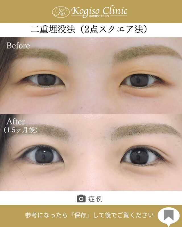 2点スクエアー法（二重埋没法）

瞼が覆い被さっていたまつ毛が根本から見えるようになり瞳に光が入るようになりました💖

🩺施術内容
上瞼に開けた小さな穴から細い埋没糸を瞼板と皮膚に
スクエアーにかけて二重のラインを形成します。
腫れがとても少なく自然な二重が可能です。

💰施術費用
2点スクエアー法保証付(二重埋没法) ¥70,000 税抜
2点スクエアー法保証無（二重埋没法）¥50,000 税抜
局所麻酔代、お薬代、検診代込み
保証付は術後１年以内に限りラインが消失してしまった場合左右1回ずつ無料で再手術が受けられます。

🔹術後の経過など
腫れ•違和感→2〜3日をピークに1週間程
内出血→稀に出る場合がございますが1週間程で消失

#二重 #二重埋没 #二重埋没法 #埋没法 #二重整形 
#目の整形 #美容整形前後 #美容外科 #美容整形 
#小木曽クリニック