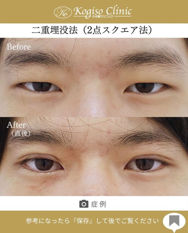 2点スクエアー法（二重埋没法）

こちらのafterのお写真は施術直後ですが
腫れが少なく、重たい瞼がすっきりしました✨

🩺施術内容
上瞼に開けた小さな穴から細い埋没糸を瞼板と皮膚に
スクエアーにかけて二重のラインを形成します。
腫れがとても少なく自然な二重が可能です。

💰施術費用
2点スクエアー法保証付(二重埋没法) ¥70,000 税抜
2点スクエアー法保証無（二重埋没法）¥50,000 税抜
局所麻酔代、お薬代、検診代込み
保証付は術後１年以内に限りラインが消失してしまった場合左右1回ずつ無料で再手術が受けられます。

🔹術後の経過など
腫れ•違和感→2〜3日をピークに1週間程
内出血→稀に出る場合がございますが1週間程で消失

#二重 #二重埋没 #二重埋没法 #埋没法 #二重整形 
#目の整形 #美容整形前後 #美容外科 #美容整形 
#小木曽クリニック