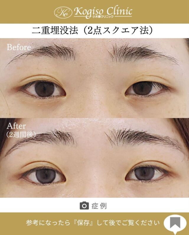 2点スクエアー法（二重埋没法）

左右非対称だった二重が左右どちらも末広のしっかり二重に✨

🩺施術内容
上瞼に開けた小さな穴から細い埋没糸を瞼板と皮膚に
スクエアーにかけて二重のラインを形成します。
腫れがとても少なく自然な二重が可能です。

💰施術費用
2点スクエアー法保証付(二重埋没法) ¥70,000 税抜
2点スクエアー法保証無（二重埋没法）¥50,000 税抜
局所麻酔代、お薬代、検診代込み
保証付は術後１年以内に限りラインが消失してしまった場合左右1回ずつ無料で再手術が受けられます。

🔹術後の経過など
腫れ•違和感→2〜3日をピークに1週間程
内出血→稀に出る場合がございますが1週間程で消失

#二重 #二重埋没 #二重埋没法 #埋没法 #二重整形 
#目の整形 #美容整形前後 #美容外科 #美容整形 
#小木曽クリニック