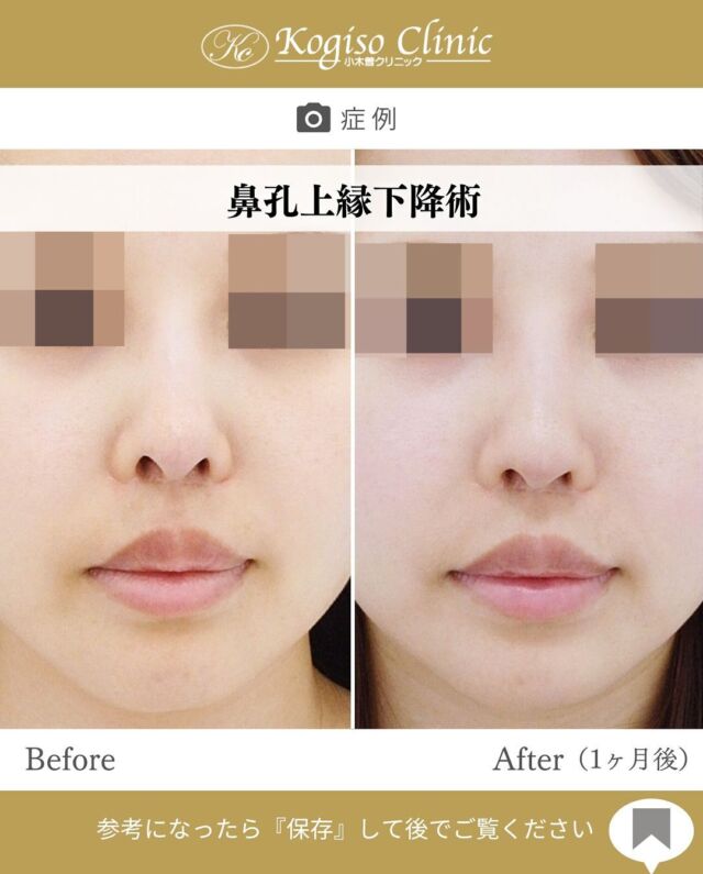 鼻孔上縁下降術

鼻の穴の上縁が上方に切れ込んでいると
鼻の穴が大きく見えたり正面や側面から鼻の中が見えてしまいます。

🩺施術内容
耳の裏側から耳介軟骨と皮膚を採取して移植片を形成し、鼻孔上縁内側を1cmほど切開、剥離し上縁を下降させて移植片を固定縫合して鼻の穴上縁を下降させる方法です。

💰施術費用
鼻孔上縁下降術　¥800,000（税抜）

🔹術後の経過など
腫れ→4〜5日をピークに1〜2週間程
テーピング→1週間テープにて固定
抜糸→10日〜2週間で抜糸
移植部位→最初は盛り上がっていますが3〜6ヶ月で目立たなくなります。傷口は外からはほとんど見えません。

#鼻 #鼻整形 #鼻の穴 #鼻孔縁下降 #鼻孔縁下降術 #鼻の整形 #鼻尖 #美容整形 #美容整形前後 #小木曽クリニック