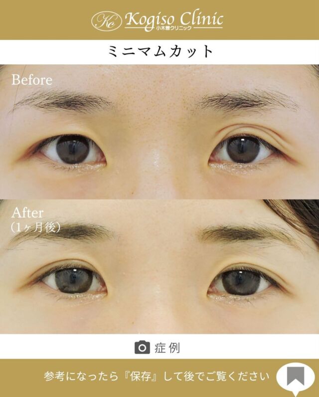 ミニマムカット法(最小切開法)

皮膚が覆い被さっていたり三重になっていたラインがすっきりとした自然な二重のラインに👀✨

【ミニマムカット法(最小切開法)】
🩺施術内容
上瞼の皮膚の被りが強い方や瞼の脂肪が多い方、モウコヒダがある方に適しており、希望の二重ラインの中央を7〜8mm切開し、余分な脂肪を取り除き瞼板との間に強い癒着によって二重ラインを形成します。

💰施術費用
ミニマムカット法(最小切開法) ¥200,000 税抜
局所麻酔代、お薬代、検診代込み
術後１年以内に限りラインが消失してしまった場合は
左右1回ずつ無料で再手術が可能です。

🔹術後の経過など
腫れ→1週間程
内出血→稀に出る場合がございますが1週間程で消失
抜糸→1週間後に抜糸
切開創部→術後は多少赤みがございますが抜糸後はメイクでカバーできる程度で、3ヶ月程でほとんど目立たなくなります。

#ミニマムカット法 #最小切開 #最小切開法  #二重 #二重整形 #目の整形 #美容整形前後 #美容整形 #美容外科 #小木曽クリニック