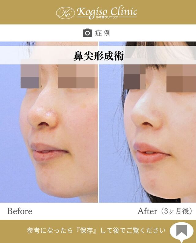 鼻尖形成術（耳介軟骨移植法）

鼻先の丸みが改善され、細く高さのある鼻先に💜

🩺施術内容
鼻柱及び鼻腔内側を切開して鼻尖部の鼻翼軟骨を露出させ、左右の鼻翼軟骨を縫縮してベースを作成します。耳介の裏側を３cm程切開して耳介軟骨を切除採取し、軟骨グラフトを作成します。作成した軟骨グラフトを鼻翼軟骨で作成したベースの先端に固定して鼻尖形成を行います。

💰施術費用
鼻尖形成術（耳介軟骨移植法） ¥700,000税抜
別途麻酔代、検査代が必要となります

🔹術後の経過など
固定→1週間テープとアクアプラスト（ギブス）で固定
腫れ→約1週間ほどで落ち着いてきます
抜糸→2週間後に抜糸
傷痕→鼻柱切開の傷痕は3ヶ月ほどで目立たなくなっていきます。術後鼻先が硬くなりますが1ヶ月〜3ヶ月程で徐々に柔らかくなっていきます。

#鼻 #鼻整形 #鼻尖形成 #鼻尖 #鼻尖形成術 #鼻尖縮小 #鼻尖縮小術 #鼻尖整形 #鼻先 #鼻先縮小 #美容整形前後 #美容整形 #小木曽クリニック