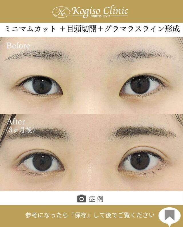 ミニマムカット法＋目頭切開術＋グラマラスライン形成•目尻下制術

目の幅が広がりより大きなお目元に💜

【ミニマムカット法(最小切開法)】
🩺施術内容
上瞼の皮膚の被りが強い方や瞼の脂肪が多い方、モウコヒダがある方に適しており、希望の二重ラインの中央を7〜8mm切開し、余分な脂肪を取り除き瞼板との間に強い癒着によって二重ラインを形成します。

💰施術費用
ミニマムカット法(最小切開法) ¥200,000 税抜
局所麻酔代、お薬代、検診代込み
術後１年以内に限りラインが消失してしまった場合は
左右1回ずつ無料で再手術が可能です。

🔹術後の経過など
腫れ→1週間程
内出血→稀に出る場合がございますが1週間程で消失
抜糸→1週間後に抜糸
切開創部→術後は多少赤みがございますが抜糸後はメイクでカバーできる程度で、3ヶ月程でほとんど目立たなくなります。

【目頭切開術】
🩺施術内容
モウコヒダの部分を4mm位のZ型に切開し三角皮弁を入れ替える術です。緊張のかからない自然な方向に皮膚を移動する為モウコヒダをスムーズになくすことができ、腫れが少なく傷跡が残りにくいです。

💰施術費用
目頭切開術 ¥250,000 税抜
局所麻酔代、お薬代、検診代込み

🔹術後の経過など
腫れ→2〜5日をピークに1週間程
内出血→稀に出る場合がございますが1〜2週間程で消失
抜糸→1週間後に抜糸
切開創部→術後は多少赤みがございますが抜糸後はメイクでカバーできる程度で、3ヶ月程でほとんど目立たなくなります。

【グラマラスライン形成•目尻下制術】
🩺施術内容
目尻側の下まぶたを切開し、瞼板を骨膜に固定して目尻および下眼瞼外側下縁を下げます。骨膜に固定する為下制効果が大きく後戻りしにくい方法です。

💰施術費用
グラマラスライン形成•目尻下制術 ¥400,000 税抜
局所麻酔代、お薬代、検診代込み

🔹術後の経過など
腫れ→2〜３日をピークに1週間程
内出血→1〜２週間
抜糸→1週間後に抜糸
切開創部→術後多少赤みがございますが抜糸後はメイクでカバーできる程度で徐々に薄くなっていきます。

#二重 #二重整形 #ミニマムカット法 #最小切開 
#目頭切開 #目頭切開術 #目頭 #目頭切開法 
#グラマラスライン #グラマラスライン形成 #タレ目形成 #目尻下制 #目尻下制手術  #美容整形前後 #目の整形 #美容整形 #美容外科 #小木曽クリニック