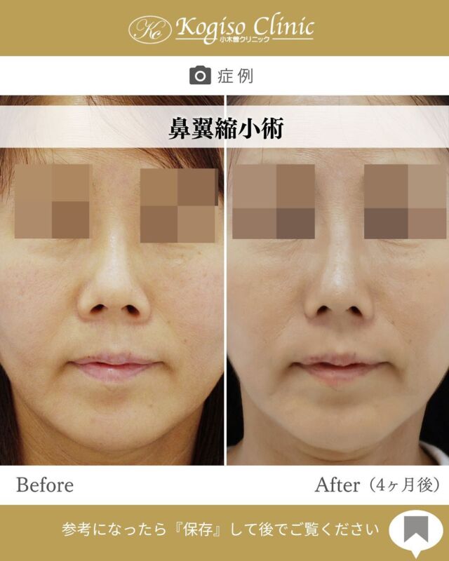 鼻翼縮小術

小鼻の広がりが改善されすっきりしたお鼻に😊

【鼻翼縮小術】
🩺施術内容
鼻腔内から小鼻の付け根にかけて皮膚を切除、縫縮して
鼻の横幅を短くします。
同時に鼻の穴を小さく縦長な形にすることができます。

💰施術費用
鼻翼縮小術 ¥300,000 税抜
局所麻酔代、お薬代、検診代込み

🔹術後の経過など
腫れはわずかで、1週間テープ固定し2週間後に抜糸を行います。傷跡は経過とともに目立たなくなり3ヶ月程でほぼ分からなくなります。

#鼻翼縮小 #鼻翼縮小術 #鼻翼 #小鼻 #小鼻縮小 #小鼻縮小術 #小鼻整形 #鼻整形 #美容整形前後 #美容整形 #美容外科 #小木曽クリニック