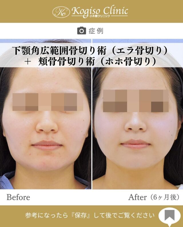下顎角広範囲骨切り術＋頬骨骨切り術

頬やエラの出っ張りがなくなり、若く女性らしい輪郭になりました✨

【下顎角広範囲骨切り術】
🩺施術内容
下顎角部の皮膚を2〜3㎝切開、骨膜下を広範囲に剥離し
オトガイ部から下顎角上方の顎関節付近までを広範囲に骨切りし、盛り上がった隆起部の外板を削るため横顔だけでなく正面顔も変化を得られます。骨切りラインは滑らかなカーブを描いているので術後のエラのラインは自然です。

💰施術費用
下顎角広範囲骨切り術 ¥1,500,000 税抜
修正の場合は上記価格に修正費がプラスとなります。
別途全身麻酔•物品•検査代計¥233,090

🔹術後の経過など
腫れ→個人差はございますが1週間をピークに2週間ほどで大きな腫れは徐々に落ち着いてきます。
圧迫固定→術後3日間は24時間フェイスバンテージにて圧迫し腫れを予防します。
検診→翌日、1ヶ月、6ヶ月　翌日検診にてドレーン抜去します。
傷痕→切開ラインは経過とともに徐々に目立たなくなっていき、個人差ございますが3〜6ヶ月で細いシワのようになります。

【頬骨骨切り術】
🩺施術内容
耳前部を1㎝切開して頬骨弓起始部を骨切り、上顎口腔粘膜を左右4㎝ほど切開し骨膜を剥離して頬骨弓から頬骨体にかけてL字型に切除し、分離骨を前内方へ移動してチタンプレートにて固定します。頬骨全体の縮小効果が得られるため、頬骨の出っ張りがなくなり若々しく見えます。

💰施術費用
頬骨骨切り術 ¥1,500,000 税抜
修正の場合は上記価格に修正費がプラスとなります。
別途全身麻酔•物品•検査代計¥233,090

🔹術後の経過など
腫れ→個人差はございますが1週間をピークに2週間ほどで大きな腫れは徐々に落ち着いてきます。
圧迫固定→術後3日間は24時間フェイスバンテージにて圧迫し腫れを予防します。
検診→翌日、1ヶ月、6ヶ月
鼻出血→上顎洞を骨切りするため術後１〜２日ほど鼻血が出ることがありますが、自然に止まります。

#輪郭 #輪郭整形 #輪郭形成 #輪郭手術 #骨切り #骨切り手術 #エラ #エラ整形 #頬骨 #頬骨縮小 #頬骨骨切り 
#輪郭整形ビフォーアフター #美容整形 #小木曽クリニック