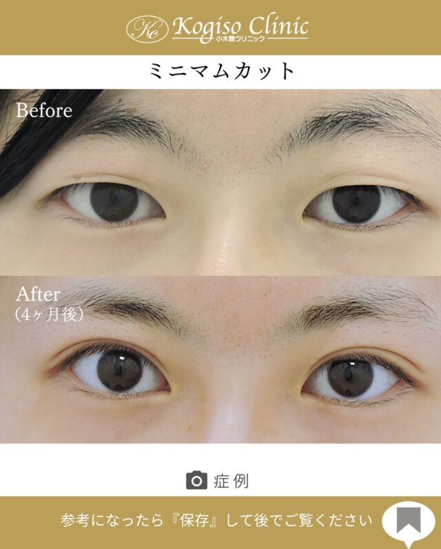 ミニマムカット法(最小切開法)

まつ毛の生え際が見える華やかな平行型に👀💜

【ミニマムカット法(最小切開法)】
🩺施術内容
上瞼の皮膚の被りが強い方や瞼の脂肪が多い方、モウコヒダがある方に適しており、希望の二重ラインの中央を7〜8mm切開し、余分な脂肪を取り除き瞼板との間に強い癒着によって二重ラインを形成します。

💰施術費用
ミニマムカット法(最小切開法) ¥200,000 税抜
局所麻酔代、お薬代、検診代込み
術後１年以内に限りラインが消失してしまった場合は
左右1回ずつ無料で再手術が可能です。

🔹術後の経過など
腫れ→1週間程
内出血→稀に出る場合がございますが1週間程で消失
抜糸→1週間後に抜糸
切開創部→術後は多少赤みがございますが抜糸後はメイクでカバーできる程度で、3ヶ月程でほとんど目立たなくなります。

#ミニマムカット法 #最小切開 #最小切開法  #二重 #二重整形 #目の整形 #美容整形前後 #美容整形 #美容外科 #小木曽クリニック