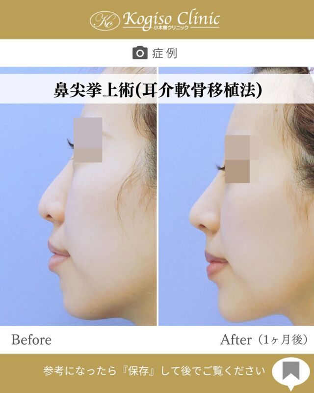 鼻尖挙上術（耳介軟骨移植法）

下がっていた鼻先が上向きになり、バランスの取れた横顔に🫶

🩺施術内容
鼻柱及び鼻腔内側を切開して、鼻尖部の鼻翼軟骨上を剥離
した後鼻中隔軟骨下端を剥離露出させ、耳介軟骨で作成したグラフトで鼻中隔軟骨を挟んで上向きに固定し鼻先の角度を調整します。

💰施術費用
鼻尖挙上術（耳介軟骨移植法） ¥700,000 税抜
別途麻酔代、検査代がかかります。

🔹術後の経過など
固定→術後1週間テープとアクアプラスト（ギブス）にて固定します
腫れ→約1週間ほど
抜糸→術後2週間後に抜糸
傷痕→鼻柱切開傷は3ヶ月程で目立たなくなっていきます
術後鼻先が硬くなりますが1〜3ヶ月程で徐々に柔らかくなっていきます

#鼻尖 #鼻整形 #鼻 #鼻尖形成 #鼻の整形 #鼻尖形成術 
#鼻尖縮小 #鼻尖挙上 #鼻尖整形 #鼻尖整形 #鼻先 
#美容整形前後 #美容整形 #小木曽クリニック