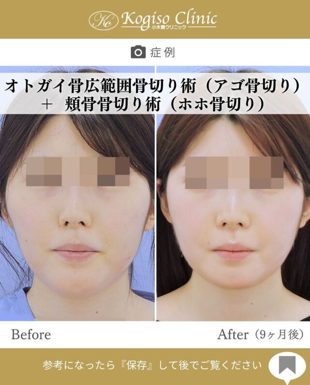 オトガイ広範囲骨切り術＋頬骨骨切り術

全体的に小さくスッキリした輪郭に✨

【オトガイ広範囲骨切り術】
🩺施術内容
当院のオトガイ広範囲骨切り術はオトガイ神経を剥離し、
オトガイ部から下顎角直前にわたりスムーズなカーブを
描きながら広範囲に骨切りするため、切除量が多く変化が大きいだけでなく自然な仕上がりです。

💰施術費用
オトガイ広範囲骨切り術 ¥1,500,000税抜
修正の場合は上記価格に修正費がプラスとなります。
別途全身麻酔•物品•検査代計 ¥233,090

🔹術後の経過など
腫れ→個人差はありますが1週間をピークに2週間ほどで大きな腫れは徐々に引いていきます
圧迫固定→術後3日間は24時間フェイスバンテージにて圧迫します
痺れ→オトガイ神経を剥離して手術を行うため、術後しばらく口の周りの感覚が鈍くなります。個人差がありますが6ヶ月程で徐々に回復していきます。
検診→翌日、1ヶ月、6ヶ月
翌日検診の際にドレーンチューブを抜去します。

【頬骨骨切り術】
🩺施術内容
耳前部を1㎝切開して頬骨弓起始部を骨切り、上顎口腔粘膜を左右4㎝ほど切開し骨膜を剥離して頬骨弓から頬骨体にかけてL字型に切除し、分離骨を前内方へ移動してチタンプレートにて固定します。頬骨全体の縮小効果が得られるため、頬骨の出っ張りがなくなり若々しく見えます。

💰施術費用
頬骨骨切り術 ¥1,500,000 税抜
修正の場合は上記価格に修正費がプラスとなります。
別途全身麻酔•物品•検査代計¥233,090

🔹術後の経過など
腫れ→個人差はございますが1週間をピークに2週間ほどで大きな腫れは徐々に落ち着いてきます。
圧迫固定→術後3日間は24時間フェイスバンテージにて圧迫し腫れを予防します。
検診→翌日、1ヶ月、6ヶ月
鼻出血→上顎洞を骨切りするため術後１〜２日ほど鼻血が出ることがありますが、自然に止まります。

#輪郭形成 #輪郭整形 #骨切り #アゴ整形 #顎 #輪郭手術 
#骨切り手術 #頬骨 #頬骨縮小 #頬骨手術 #頬骨骨切り #輪郭整形ビフォーアフター #輪郭整形症例写真 #顔面整形 #美容整形前後 #美容整形 #美容外科 #小木曽クリニック
