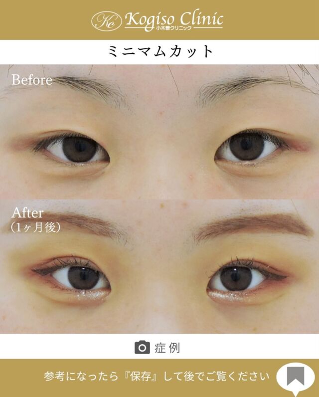 ミニマムカット法(最小切開法)

末広二重で自然にぱっちりしたお目元に😊

【ミニマムカット法(最小切開法)】
🩺施術内容
上瞼の皮膚の被りが強い方や瞼の脂肪が多い方、モウコヒダがある方に適しており、希望の二重ラインの中央を7〜8mm切開し、余分な脂肪を取り除き瞼板との間に強い癒着によって二重ラインを形成します。

💰施術費用
ミニマムカット法(最小切開法) ¥200,000 税抜
局所麻酔代、お薬代、検診代込み
術後１年以内に限りラインが消失してしまった場合は
左右1回ずつ無料で再手術が可能です。

🔹術後の経過など
腫れ→1週間程
内出血→稀に出る場合がございますが1週間程で消失
抜糸→1週間後に抜糸
切開創部→術後は多少赤みがございますが抜糸後はメイクでカバーできる程度で、3ヶ月程でほとんど目立たなくなります。

#ミニマムカット法 #最小切開 #最小切開法  #二重 #二重整形 #目の整形 #美容整形前後 #美容整形 #美容外科 #小木曽クリニック