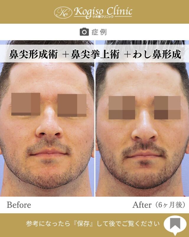 鼻尖形成術＋鼻尖挙上術＋わし鼻形成術

下向きの鼻先・わし鼻のライン・丸みのある鼻尖にお悩みだった方に対し、３つの施術を組み合わせてデザイン。
🔹鼻尖挙上:下がり気味だった鼻先を自然な角度で上向きに。表情も柔らかく見えるようになります。
🔹鼻尖形成:丸く広がった鼻尖を引き締めてシャープな印象に。
🔹わし鼻形成:鼻骨の段差を削ることで鼻筋のラインがなめらかに。
正面・斜め・横顔すべてでバランスの整った鼻立ちに✨
自然でありながら、印象はしっかり変わります！

#鼻尖 #鼻尖縮小 #鼻 #鼻整形 #鼻尖形成 #わし鼻 #わし鼻修正 #わし鼻削り #鼻尖挙上 #美容整形前後 #小木曽クリニック