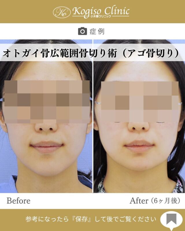 オトガイ広範囲骨切り術

お顔の縦幅が整い、バランスの取れた輪郭に🫶

【オトガイ広範囲骨切り術】
🩺施術内容
当院のオトガイ広範囲骨切り術はオトガイ神経を剥離し、
オトガイ部から下顎角直前にわたりスムーズなカーブを
描きながら広範囲に骨切りするため、切除量が多く変化が大きいだけでなく自然な仕上がりです。

💰施術費用
オトガイ広範囲骨切り術 ¥1,500,000〜税抜
修正の場合は上記価格に修正費がプラスとなります。
別途全身麻酔•物品•検査代計 ¥233,090

🔹術後の経過など
腫れ→個人差はありますが1週間をピークに2週間ほどで大きな腫れは徐々に引いていきます
圧迫固定→術後3日間は24時間フェイスバンテージにて圧迫します
痺れ→オトガイ神経を剥離して手術を行うため、術後しばらく口の周りの感覚が鈍くなります。個人差がありますが6ヶ月程で徐々に回復していきます。
検診→翌日、1ヶ月、6ヶ月
翌日検診の際にドレーンチューブを抜去します。

#輪郭形成 #輪郭整形 #骨切り #アゴ整形 #顎 #輪郭手術 
#骨切り手術 #輪郭整形ビフォーアフター #輪郭整形症例写真 #顔面整形#フェイスライン #美容整形前後 #美容整形 #美容外科 #小木曽クリニック
