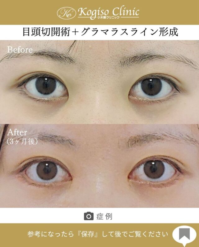 目頭切開術＋グラマラスライン形成•目尻下制術

目の幅が広がりより大きなお目元に💜

【目頭切開術】
🩺施術内容
モウコヒダの部分を4mm位のZ型に切開し三角皮弁を入れ替える術です。緊張のかからない自然な方向に皮膚を移動する為モウコヒダをスムーズになくすことができ、腫れが少なく傷跡が残りにくいです。

💰施術費用
目頭切開術 ¥250,000 税抜
局所麻酔代、お薬代、検診代込み

🔹術後の経過など
腫れ→2〜5日をピークに1週間程
内出血→稀に出る場合がございますが1〜2週間程で消失
抜糸→1週間後に抜糸
切開創部→術後は多少赤みがございますが抜糸後はメイクでカバーできる程度で、3ヶ月程でほとんど目立たなくなります。

【グラマラスライン形成•目尻下制術】
🩺施術内容
目尻側の下まぶたを切開し、瞼板を骨膜に固定して目尻および下眼瞼外側下縁を下げます。骨膜に固定する為下制効果が大きく後戻りしにくい方法です。

💰施術費用
グラマラスライン形成•目尻下制術 ¥400,000 税抜
局所麻酔代、お薬代、検診代込み

🔹術後の経過など
腫れ→2〜３日をピークに1週間程
内出血→1〜２週間
抜糸→1週間後に抜糸
切開創部→術後多少赤みがございますが抜糸後はメイクでカバーできる程度で徐々に薄くなっていきます。

#目頭切開 #目頭切開術 #目頭 #目頭切開法 
#グラマラスライン #グラマラスライン形成 #タレ目形成 #目尻下制 #目尻下制手術  #美容整形前後 #目の整形 #美容整形 #美容外科 #小木曽クリニック