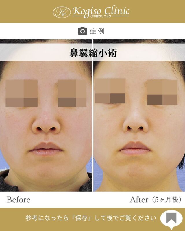 鼻翼縮小術

小鼻の広がりが改善されすっきりしたお鼻に😊

【鼻翼縮小術】
🩺施術内容
鼻腔内から小鼻の付け根にかけて皮膚を切除、縫縮して
鼻の横幅を短くします。
同時に鼻の穴を小さく縦長な形にすることができます。

💰施術費用
鼻翼縮小術 ¥300,000 税抜
局所麻酔代、お薬代、検診代込み

🔹術後の経過など
腫れはわずかで、1週間テープ固定し2週間後に抜糸を行います。傷跡は経過とともに目立たなくなり3ヶ月程でほぼ分からなくなります。

#鼻翼縮小 #鼻翼縮小術 #鼻翼 #小鼻 #小鼻縮小 #小鼻縮小術 #小鼻整形 #鼻整形 #美容整形前後 #美容整形 #美容外科 #小木曽クリニック