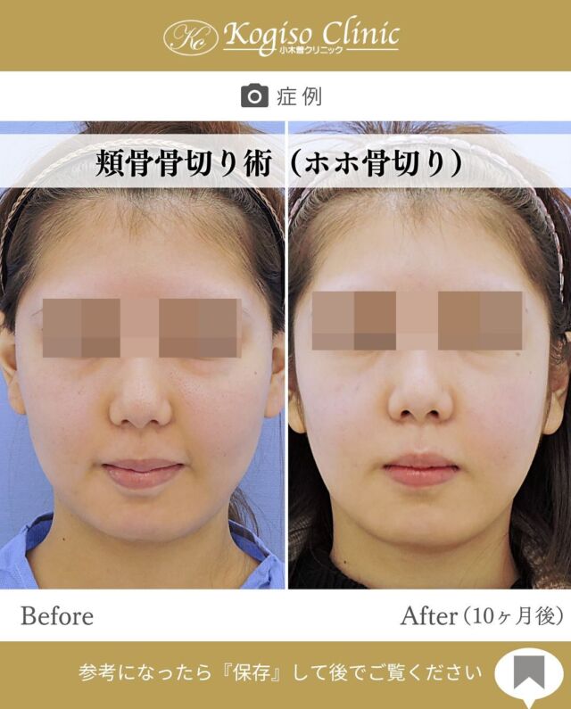 【頬骨骨切り術】
🩺施術内容
耳前部を1㎝切開して頬骨弓起始部を骨切り、上顎口腔粘膜を左右4㎝ほど切開し骨膜を剥離して頬骨弓から頬骨体にかけてL字型に切除し、分離骨を前内方へ移動してチタンプレートにて固定します。頬骨全体の縮小効果が得られるため、頬骨の出っ張りがなくなり若々しく見えます。

💰施術費用
頬骨骨切り術 ¥1,500,000 税抜
修正の場合は上記価格に修正費がプラスとなります。
別途全身麻酔•物品•検査代計¥233,090

🔹術後の経過など
腫れ→個人差はございますが1週間をピークに2週間ほどで大きな腫れは徐々に落ち着いてきます。
圧迫固定→術後3日間は24時間フェイスバンテージにて圧迫し腫れを予防します。
検診→翌日、1ヶ月、6ヶ月
鼻出血→上顎洞を骨切りするため術後１〜２日ほど鼻血が出ることがありますが、自然に止まります。

#輪郭形成 #輪郭整形 #骨切り #輪郭手術 #骨切り手術 #頬骨 #頬骨縮小 #頬骨手術 #頬骨骨切り #輪郭整形ビフォーアフター #輪郭整形症例写真 #顔面整形 #美容整形前後 #美容整形 #美容外科 #小木曽クリニック