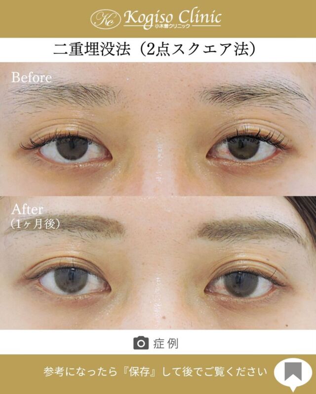 2点スクエアー法（二重埋没法）

皮膚が伸びて何重にもなってぼやけていたラインが
しっかり二重になりました✨

🩺施術内容
上瞼に開けた小さな穴から細い埋没糸を瞼板と皮膚に
スクエアーにかけて二重のラインを形成します。
腫れがとても少なく自然な二重が可能です。

💰施術費用
2点スクエアー法保証付(二重埋没法) ¥70,000 税抜
2点スクエアー法保証無（二重埋没法）¥50,000 税抜
局所麻酔代、お薬代、検診代込み
保証付は術後１年以内に限りラインが消失してしまった場合左右1回ずつ無料で再手術が受けられます。

🔹術後の経過など
腫れ•違和感→2〜3日をピークに1週間程
内出血→稀に出る場合がございますが1週間程で消失

#二重 #二重埋没 #二重埋没法 #埋没法 #二重整形 
#目の整形 #美容整形前後 #美容外科 #美容整形 
#小木曽クリニック