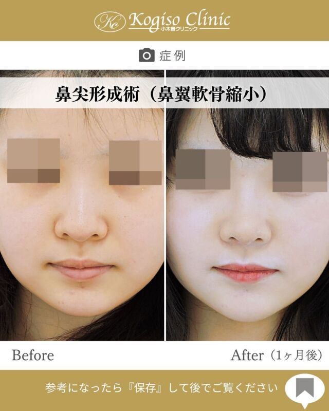 鼻尖形成術（鼻翼軟骨縮小）

鼻先の丸みが改善され、自然に上向きな鼻先に💜

🩺施術内容
鼻柱及び鼻腔内側を切開して鼻尖部の鼻翼軟骨を露出させ、鼻翼軟骨下の鼻腔粘膜との間を慎重に剥離して外側部で軟骨を切離して反転させ、中央で縫縮することで鼻尖部の高さと細さを形成します。

💰施術費用
鼻尖形成術（鼻翼軟骨縮小） ¥500,000 税抜

🔹術後の経過など
固定→1週間テープとアクアプラスト（ギブス）で固定
腫れ→約1週間ほどで落ち着いてきます
抜糸→2週間後に抜糸
傷痕→鼻柱切開の傷痕は3ヶ月ほどで目立たなくなっていきます。術後鼻先が硬くなりますが1ヶ月〜3ヶ月程で徐々に柔らかくなっていきます。

#鼻 #鼻整形 #鼻尖形成 #鼻尖 #鼻尖形成術 #鼻尖縮小 #鼻尖縮小術 #鼻尖整形 #鼻先 #鼻先縮小 #美容整形前後 #美容整形 #小木曽クリニック