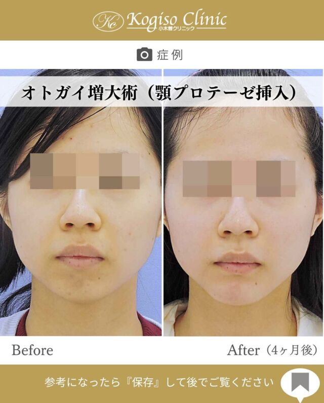 オトガイ増大術(顎プロテーゼ挿入)

口ゴボが目立たなくなりすてきな横顔になりました🫶

【オトガイ増大術(顎プロテーゼ挿入)】
🩺施術内容
口腔内を切開し、骨膜下を剥離してシリコンプロテーゼを
挿入します。
💰施術費用
顎プロテーゼ挿入術 ¥300,000 税抜
局所麻酔代、お薬代、検診代込み
チタンプレート固定される場合　¥500,000 税抜
チタンプレート固定は全身麻酔で行う為別途麻酔代、全身麻酔に必要な術前検査代が必要となります。
入替の場合は費用が変動します。

#プロテーゼ #顎プロテーゼ #顎プロテーゼ挿入術 #顎なし #口ゴボ #顎 #アゴプロ 
#美容整形前後 #美容整形 #美容外科 #小木曽クリニック