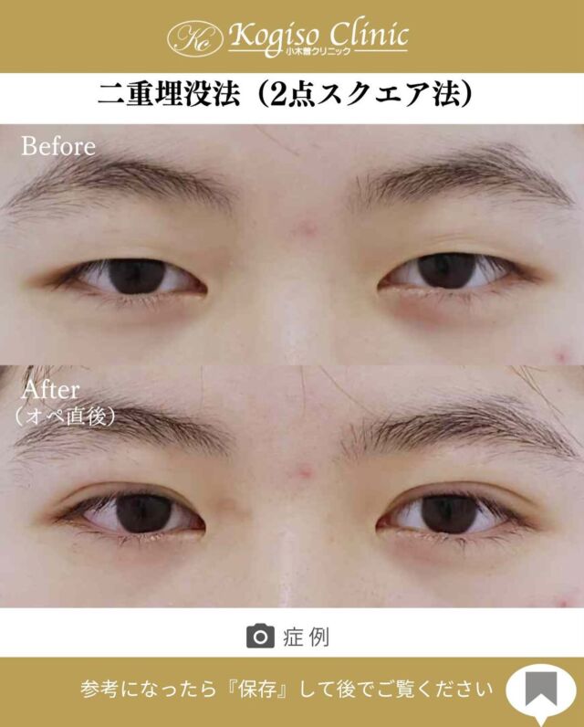🚨サマーキャンペーン実施中🚨
お目元のご手術がお得に受けられるキャンペーン中❣️
詳しくは公式LINEのキャンペーンをご覧ください🙌

2点スクエアー法（二重埋没）

OPE直後ですが腫れが少なく
重い瞼が改善されぱっちりとしたお目元に✨

🩺施術内容
上瞼に開けた小さな穴から細い埋没糸を瞼板と皮膚に
スクエアーにかけて二重のラインを形成します。
腫れがとても少なく自然な二重が可能です。

💰施術費用
2点スクエアー法保証付(二重埋没法) ¥70,000 税抜
2点スクエアー法保証無（二重埋没法）¥50,000 税抜
局所麻酔代、お薬代、検診代込み
保証付は術後１年以内に限りラインが消失してしまった場合左右1回ずつ無料で再手術が受けられます。

🔹術後の経過など
腫れ•違和感→2〜3日をピークに1週間程
内出血→稀に出る場合がございますが1週間程で消失

#二重 #二重埋没 #二重埋没法 #埋没法 #二重整形 
#目の整形 #美容整形前後 #美容外科 #美容整形 
#小木曽クリニック