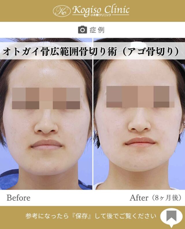 オトガイ広範囲骨切り術

アゴの突出感が改善されすっきりした輪郭に💜

【オトガイ広範囲骨切り術】
🩺施術内容
当院のオトガイ広範囲骨切り術はオトガイ神経を剥離し、
オトガイ部から下顎角直前にわたりスムーズなカーブを
描きながら広範囲に骨切りするため、切除量が多く変化が大きいだけでなく自然な仕上がりです。

💰施術費用
オトガイ広範囲骨切り術 ¥1,500,000〜税抜
修正の場合は上記価格に修正費がプラスとなります。
別途全身麻酔•物品•検査代計 ¥233,090

🔹術後の経過など
腫れ→個人差はありますが1週間をピークに2週間ほどで大きな腫れは徐々に引いていきます
圧迫固定→術後3日間は24時間フェイスバンテージにて圧迫します
痺れ→オトガイ神経を剥離して手術を行うため、術後しばらく口の周りの感覚が鈍くなります。個人差がありますが6ヶ月程で徐々に回復していきます。
検診→翌日、1ヶ月、6ヶ月
翌日検診の際にドレーンチューブを抜去します。

#輪郭形成 #輪郭整形 #骨切り #アゴ整形 #顎 #下顎前突 #輪郭手術 #骨切り手術 #輪郭整形ビフォーアフター #輪郭整形症例写真 #顔面整形#フェイスライン #美容整形前後 #美容整形 #美容外科 #小木曽クリニック