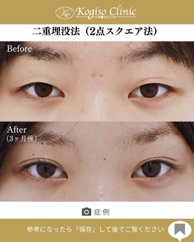 🚨サマーキャンペーン実施中🚨
お目元のご手術がお得に受けられるキャンペーン中❣️
詳しくは公式LINEのキャンペーンをご覧ください🙌

2点スクエアー法（二重埋没）

瞼が覆い被さっていたまつ毛が根本から見えるようになり瞳に光が入るぱっちり二重の明るいお目元に🤩

🩺施術内容
上瞼に開けた小さな穴から細い埋没糸を瞼板と皮膚に
スクエアーにかけて二重のラインを形成します。
腫れがとても少なく自然な二重が可能です。

💰施術費用
2点スクエアー法保証付(二重埋没法) ¥70,000 税抜
2点スクエアー法保証無（二重埋没法）¥50,000 税抜
局所麻酔代、お薬代、検診代込み
保証付は術後１年以内に限りラインが消失してしまった場合左右1回ずつ無料で再手術が受けられます。

🔹術後の経過など
腫れ•違和感→2〜3日をピークに1週間程
内出血→稀に出る場合がございますが1週間程で消失

#二重 #二重埋没 #二重埋没法 #埋没法 #二重整形 
#目の整形 #美容整形前後 #美容外科 #美容整形 
#小木曽クリニック