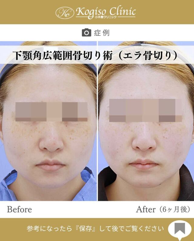 下顎角広範囲骨切り術

エラの張り出しが無くなりシャープな輪郭に☺️
モニター募集も行っておりますので
お気軽にお問い合わせくださいませ🫶
お問い合わせは公式LINEまたはお電話にて！

【下顎角広範囲骨切り術】
🩺施術内容
下顎角部の皮膚を2〜3㎝切開、骨膜下を広範囲に剥離し
オトガイ部から下顎角上方の顎関節付近までを広範囲に骨切りし、盛り上がった隆起部の外板を削るため横顔だけでなく正面顔も変化を得られます。骨切りラインは滑らかなカーブを描いているので術後のエラのラインは自然です。

💰施術費用
下顎角広範囲骨切り術 ¥1,500,000 税抜
修正の場合は上記価格に修正費がプラスとなります。
別途全身麻酔•物品•検査代計¥233,090

🔹術後の経過など
腫れ→個人差はございますが1週間をピークに2週間ほどで大きな腫れは徐々に落ち着いてきます。
圧迫固定→術後3日間は24時間フェイスバンテージにて圧迫し腫れを予防します。
検診→翌日、1ヶ月、6ヶ月　翌日検診にてドレーン抜去します。
傷痕→切開ラインは経過とともに徐々に目立たなくなっていき、個人差ございますが3〜6ヶ月で細いシワのようになります。

#輪郭 #輪郭整形 #輪郭形成 #輪郭手術 #骨切り #骨切り手術 #エラ #エラ張り #エラ張り改善 #エラ骨切り #エラ整形 #輪郭整形ビフォーアフター #美容整形 #小木曽クリニック