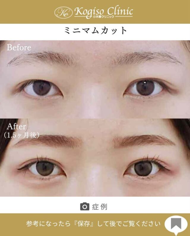 ミニマムカット法(最小切開法)

目頭側からしっかり二重になり可愛らしいお目元に😍

【ミニマムカット法(最小切開法)】
🩺施術内容
上瞼の皮膚の被りが強い方や瞼の脂肪が多い方、モウコヒダがある方に適しており、希望の二重ラインの中央を7〜8mm切開し、余分な脂肪を取り除き瞼板との間に強い癒着によって二重ラインを形成します。

💰施術費用
ミニマムカット法(最小切開法) ¥200,000 税抜
局所麻酔代、お薬代、検診代込み
術後１年以内に限りラインが消失してしまった場合は
左右1回ずつ無料で再手術が可能です。

🔹術後の経過など
腫れ→1週間程
内出血→稀に出る場合がございますが1週間程で消失
抜糸→1週間後に抜糸
切開創部→術後は多少赤みがございますが抜糸後はメイクでカバーできる程度で、3ヶ月程でほとんど目立たなくなります。

#ミニマムカット法 #最小切開 #最小切開法  #二重 #二重整形 #目の整形 #美容整形前後 #美容整形 #美容外科 #小木曽クリニック