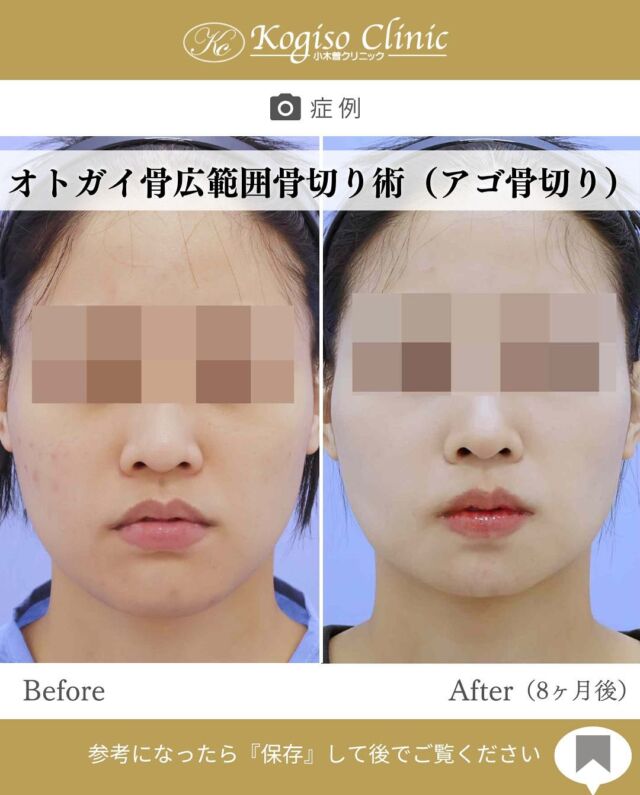 オトガイ広範囲骨切り術

アゴが短くなり自然な小顔に🫶

【オトガイ広範囲骨切り術】
🩺施術内容
当院のオトガイ広範囲骨切り術はオトガイ神経を剥離し、
オトガイ部から下顎角直前にわたりスムーズなカーブを
描きながら広範囲に骨切りするため、切除量が多く変化が大きいだけでなく自然な仕上がりです。

💰施術費用
オトガイ広範囲骨切り術 ¥1,500,000〜税抜
修正の場合は上記価格に修正費がプラスとなります。
別途全身麻酔•物品•検査代計 ¥233,090

🔹術後の経過など
腫れ→個人差はありますが1週間をピークに2週間ほどで大きな腫れは徐々に引いていきます
圧迫固定→術後3日間は24時間フェイスバンテージにて圧迫します
痺れ→オトガイ神経を剥離して手術を行うため、術後しばらく口の周りの感覚が鈍くなります。個人差がありますが6ヶ月程で徐々に回復していきます。
検診→翌日、1ヶ月、6ヶ月
翌日検診の際にドレーンチューブを抜去します。

#輪郭形成 #輪郭整形 #骨切り #アゴ整形 #顎 #下顎前突 #輪郭手術 #骨切り手術 #輪郭整形ビフォーアフター #輪郭整形症例写真 #顔面整形#フェイスライン #美容整形前後 #美容整形 #美容外科 #小木曽クリニック
