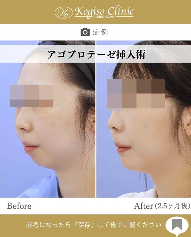 オトガイ増大術(顎プロテーゼ挿入)

アゴの後退が目立たなくなり、すてきな横顔に✨

【オトガイ増大術(顎プロテーゼ挿入)】
🩺施術内容
口腔内を切開し、骨膜下を剥離してシリコンプロテーゼを
挿入します。
💰施術費用
顎プロテーゼ挿入術 ¥300,000 税抜
局所麻酔代、お薬代、検診代込み
チタンスクリュー固定される場合　¥500,000 税抜
チタンスクリュー固定は全身麻酔で行う為別途麻酔代、全身麻酔に必要な術前検査代が必要となります。
入替の場合は費用が変動します。

#プロテーゼ #顎プロテーゼ #顎プロテーゼ挿入術 #顎なし #口ゴボ #顎 #アゴプロ 
#美容整形前後 #美容整形 #美容外科 #小木曽クリニック